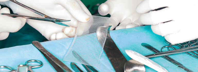 surgical mesh equipment